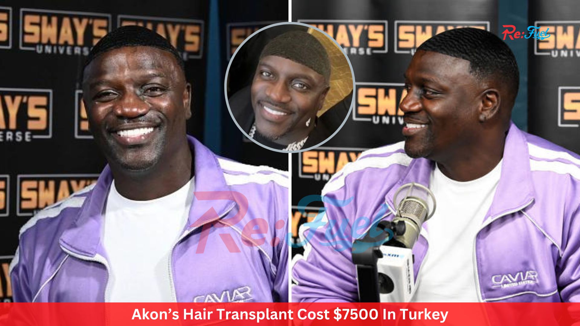 Akon’s Hair Transplant Cost $7500 In Turkey: Praises Turkey Hair Transplant, Gets Roasted